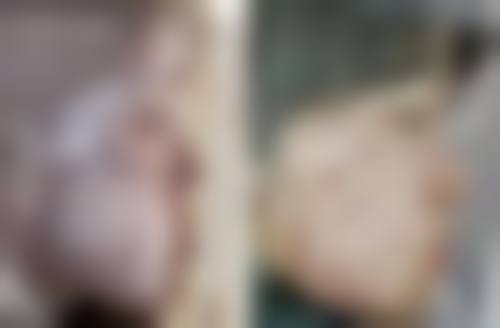 三、影响瘦脸针见效时间的因素