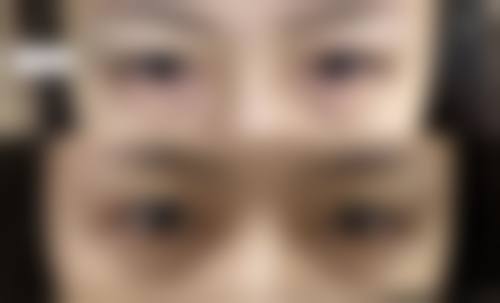 七、刀疤疤痕修复成效的影响因素