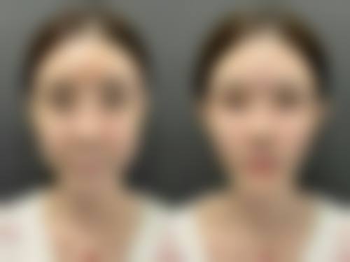 一、隆胸手术时间要多久——整体情况