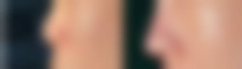 三、隆胸手术时间要多久——不同类型手术时间细化