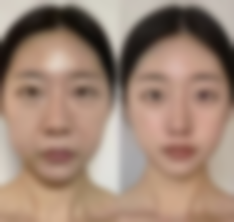 刀疤疤痕如何修复？总结与鼓励