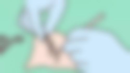 五、达拉斯隆鼻是用肋骨吗？选好隆鼻方案特别重要