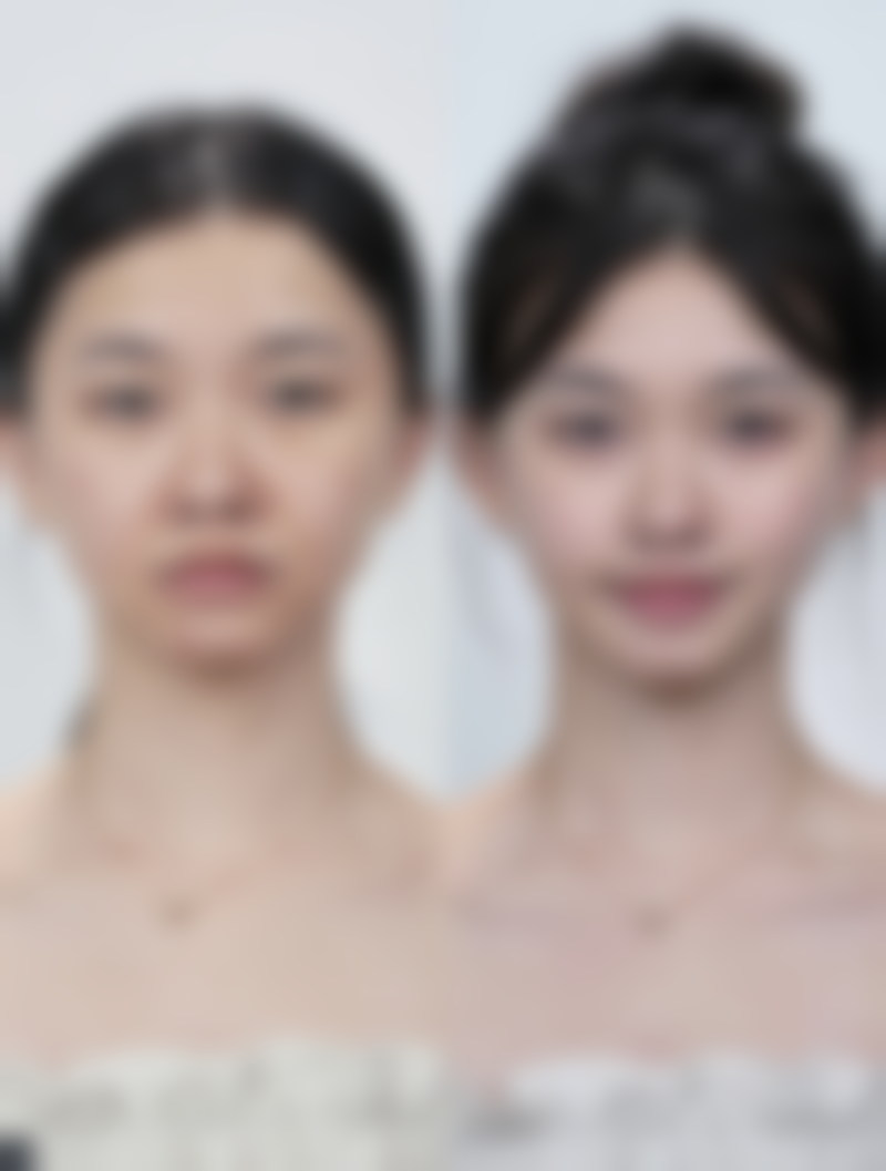 一、如何认识疤痕增生疤痕