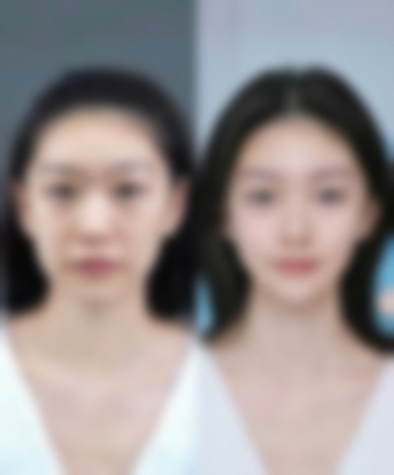 二、达拉斯隆鼻是用肋骨吗？看看它和肋骨鼻的区别