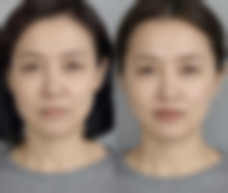 有骨膜贴片隆鼻吗？了解其原理、费用及手术流程让你隆鼻不再迷茫 