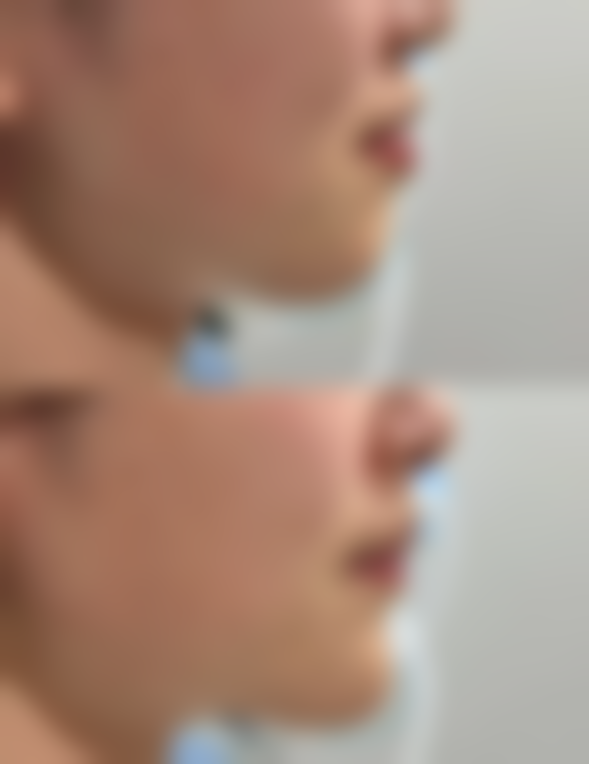 五、烫伤疤痕印怎么去掉之日常护理与注意事项