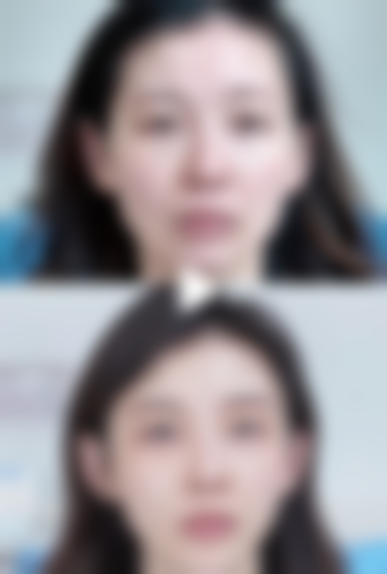 一、骨膜贴片隆鼻的原理