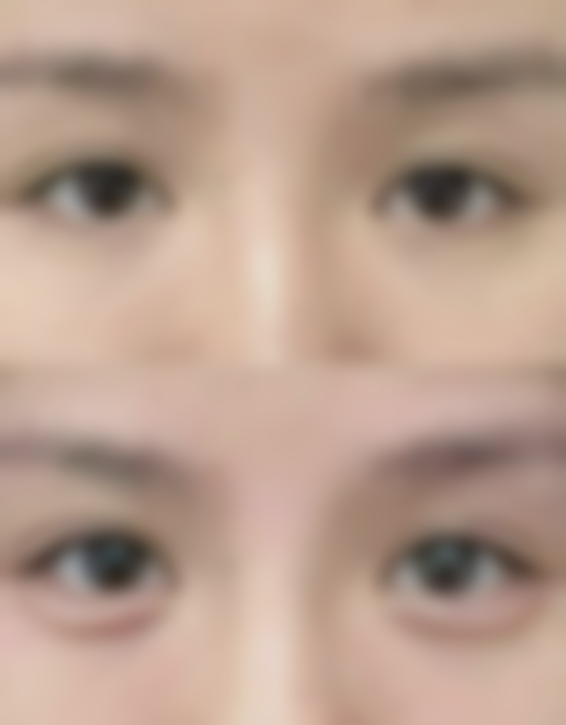 二、光子嫩肤和瘦脸针能否一起做