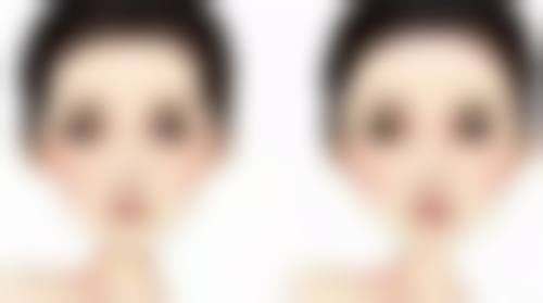 四、拆埋线双眼皮的护理要点