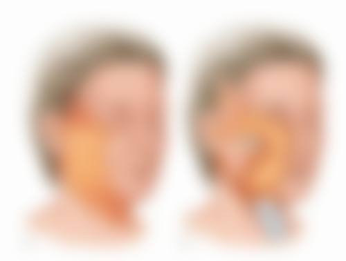 四、肚子吸脂的美学注意事项