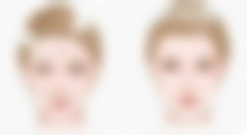 五、缝针所疤痕美学改善的注意事项