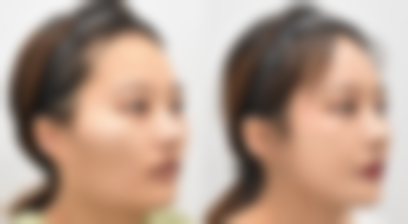 做了埋线双眼皮还能做全切吗？了解手术可行性与价格因素很重要！ 