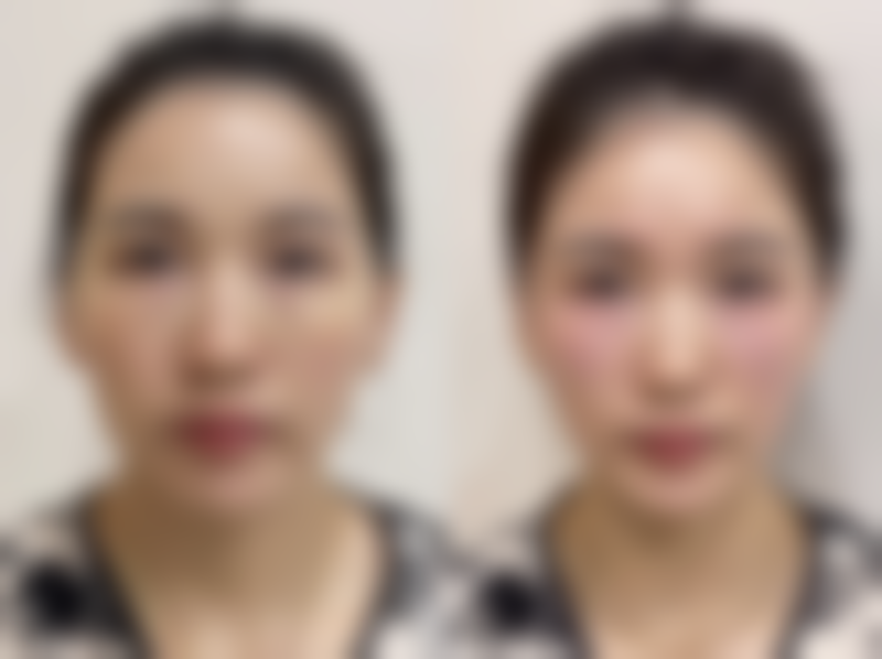 五、如何降低瘦脸针的危害和副作用