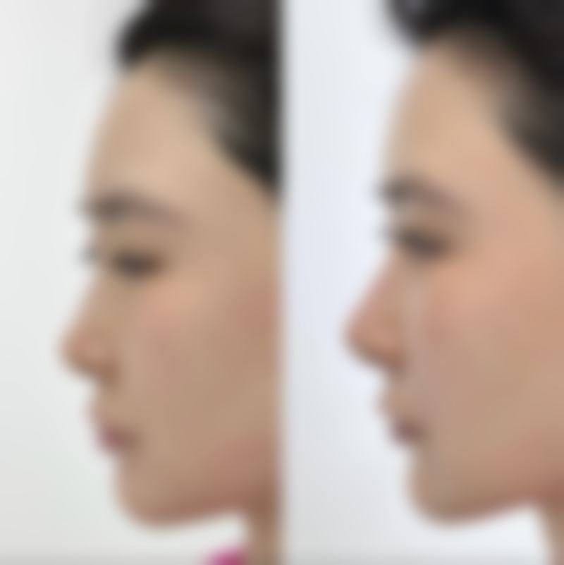 做了埋线双眼皮还能做全切吗？