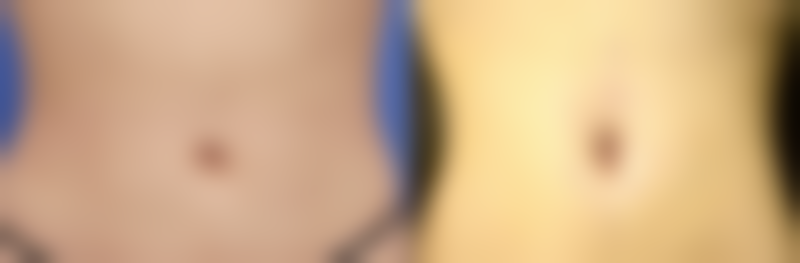 六、缝针所疤痕护理的心态调整