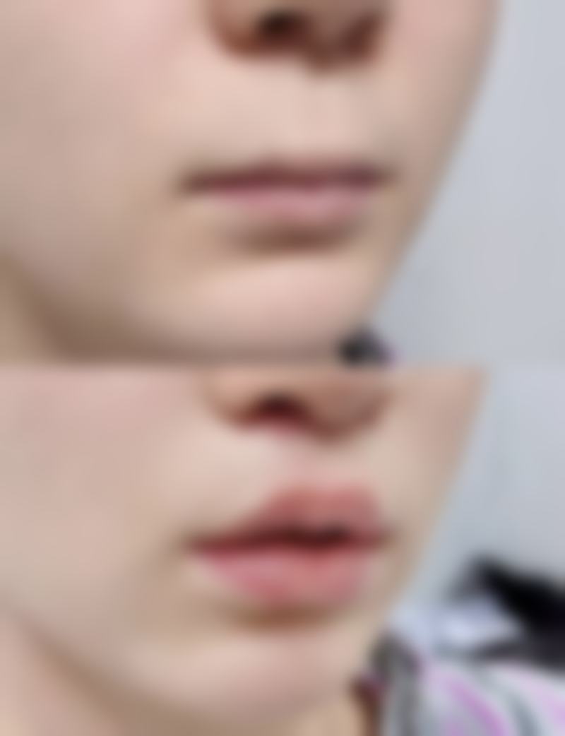 瘦脸针的危害有什么副作用 坏处？面部僵硬、不对称、过敏等风险需警惕！ 