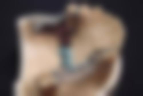 一、小阴唇缩小有什么危害——手术导致的危害