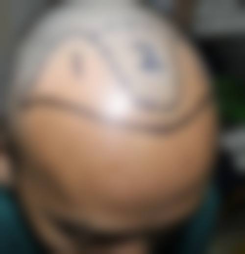 一、南京长江医院植发科正规吗？