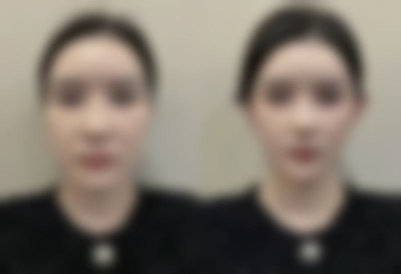 一、种植头发的适用人群和原理