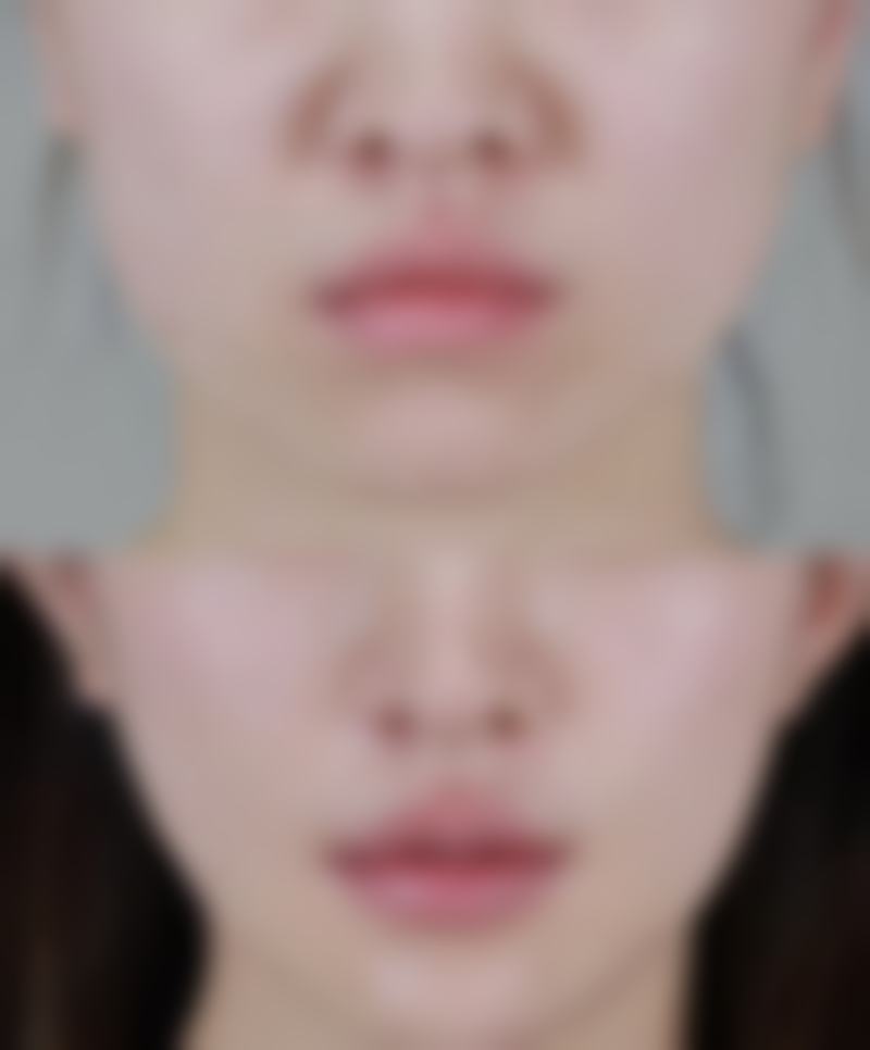 {割双眼皮提肌有什么危害？矫正过度、闭眼不全等风险需提前知晓！ 