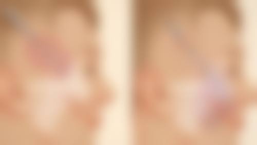 四、从美学角度看双眼皮拆线与免拆线