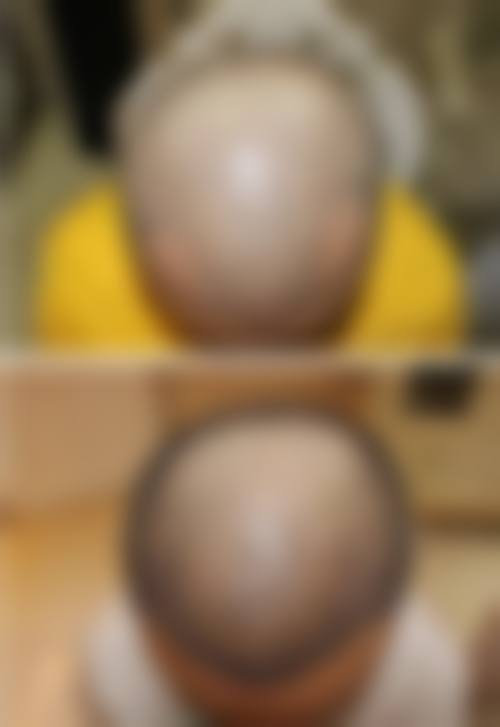 四、合肥源森植发医院特色项目