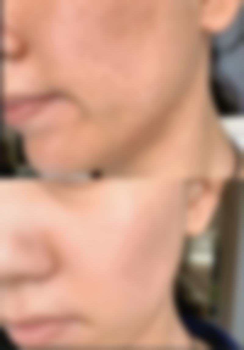 {胸前疤痕性疙瘩怎么治？多种方法综合应对，有效改善疤痕问题！ 