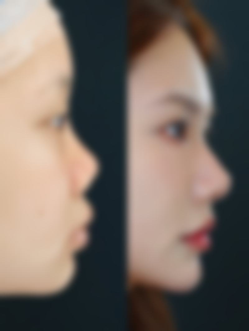 三、双眼皮拆线与免拆线的人群选择