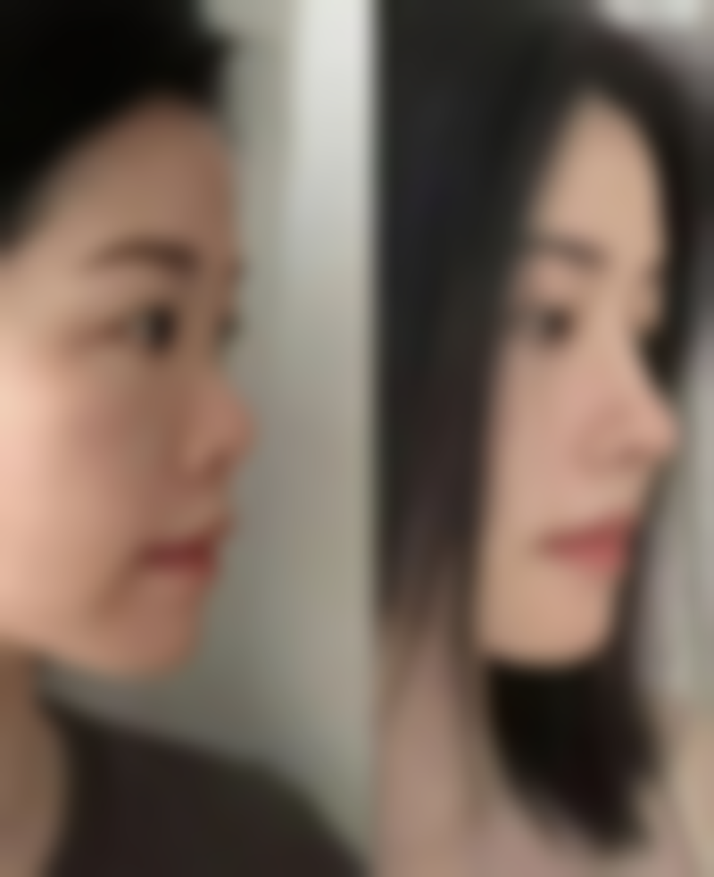 六、打完瘦脸针冰敷会影响成效吗：术后修复情况