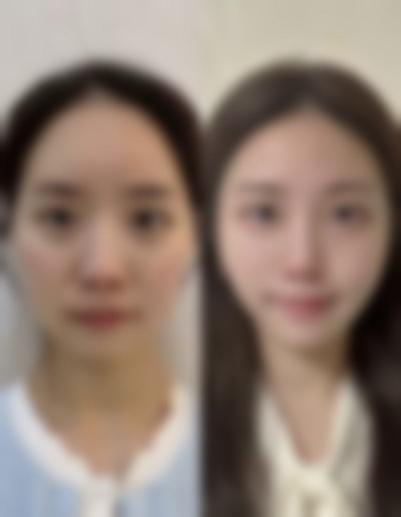 三、去眼袋什么方法好吗之医疗美容去眼袋