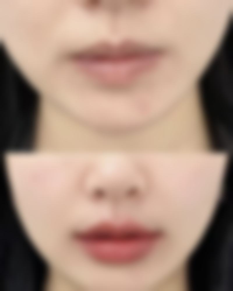 六、如果女人有眼袋，治疗前后要注意