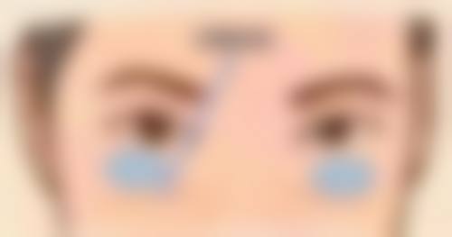 一、双眼皮下垂的主要原因大剖析
