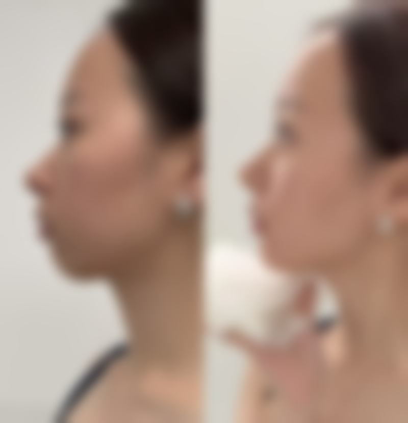 四、怎样能去眼袋和眼袋纹之其他辅助方法