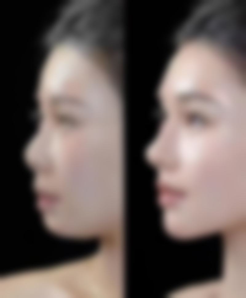 一、女人减肥抽脂的基本认知