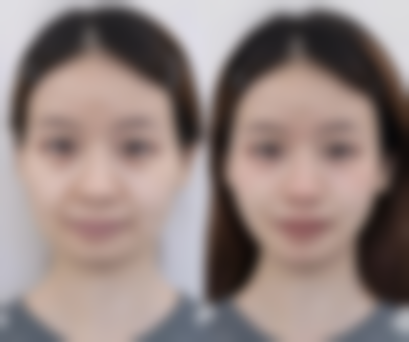 双眼皮下垂是什么原因导致的？衰老、习惯、疾病等因素大揭秘 