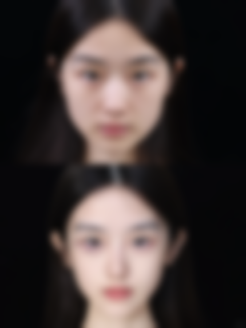 三、针对性改善双眼皮下垂的方案