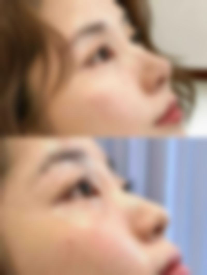 六、瘦脸针打完后多久有成效：变得更美小贴士