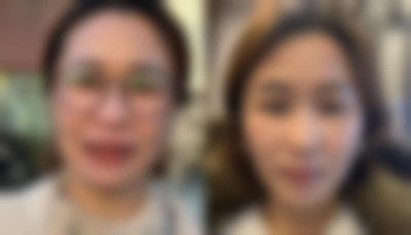 四、日常护理预防双眼皮下垂