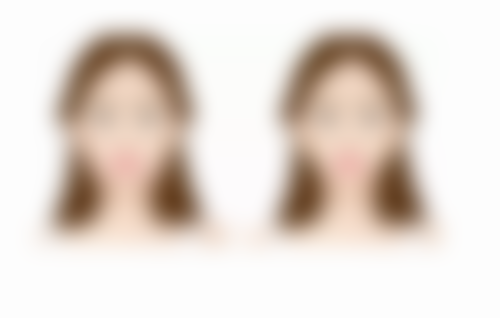 一、大腿吸脂后伤口护理注意事项