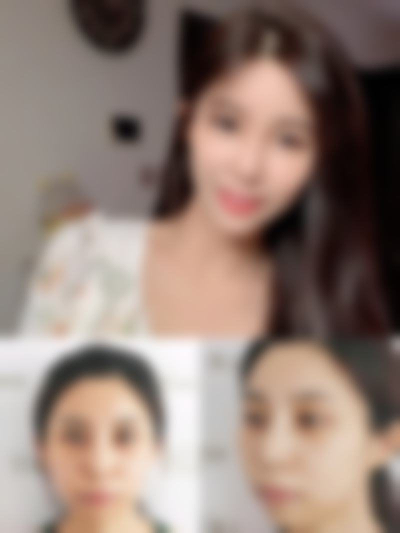 三、双眼皮第十二天怎么还是肿？改善方案大揭秘