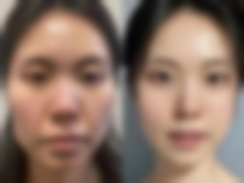 二、影响微针去眼袋维持时间的关键因素