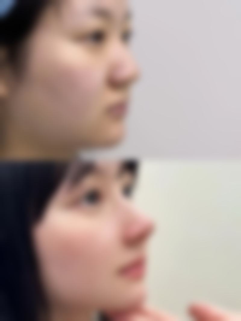 双眼皮第十二天怎么还是肿呢？术后肿胀原因、自测及改善方案全揭秘！ 