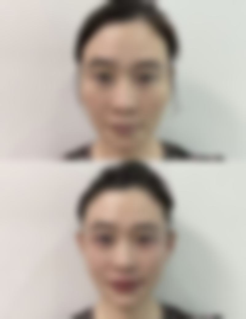 一、隆鼻手术修复的基本情况