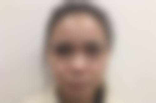 三、手术去眼袋修复期的阶段划分及表现