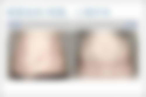 {切双眼皮和切眉哪个好？对比适用人群、效果及伤害程度，看完不再纠结！ 