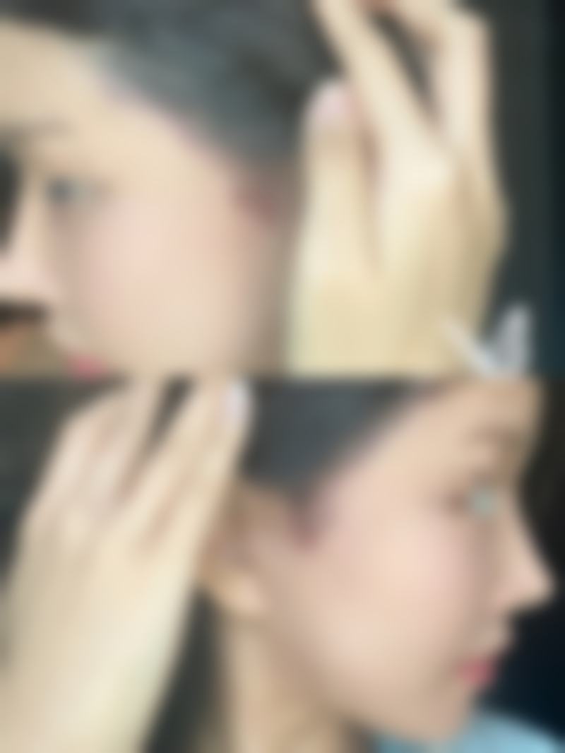 二、割双眼皮出门可选择的遮挡好物