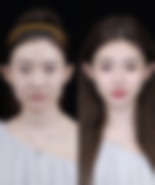 {手术去眼袋恢复期要多久才能恢复？了解不同因素影响，掌握恢复时间秘籍！ 