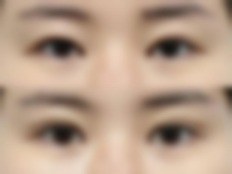 四、吸脂减肥的风险有哪些？