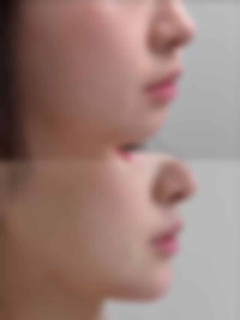 四、吸脂手术局麻疼吗之美观与修复问题