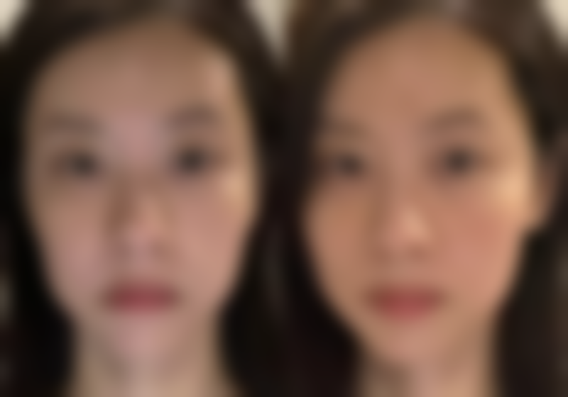 五、吸脂手术局麻疼吗之个性化方案与心态调整